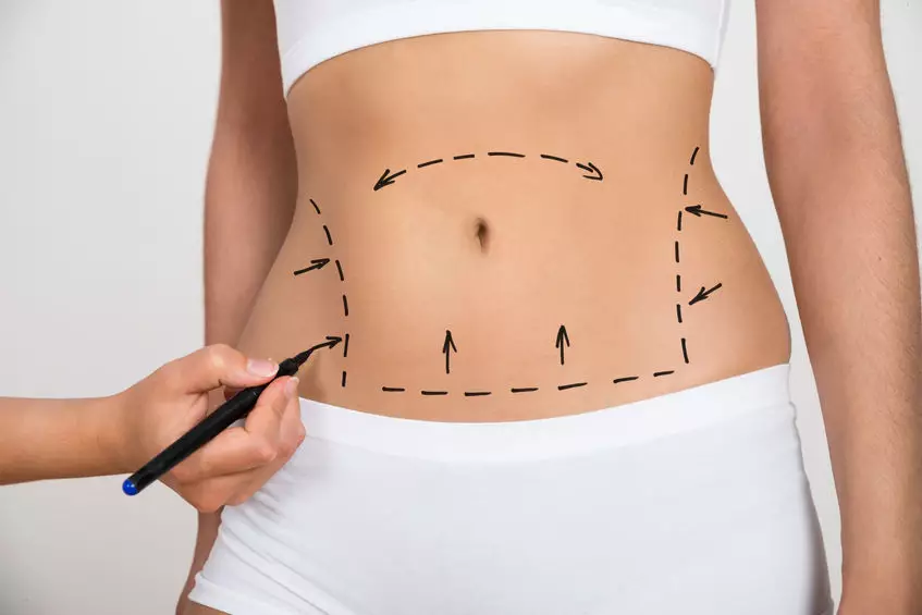 Lipoaspiração